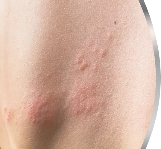 shingles blisters