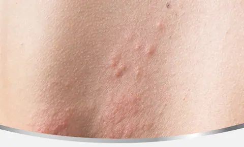 shingles blisters